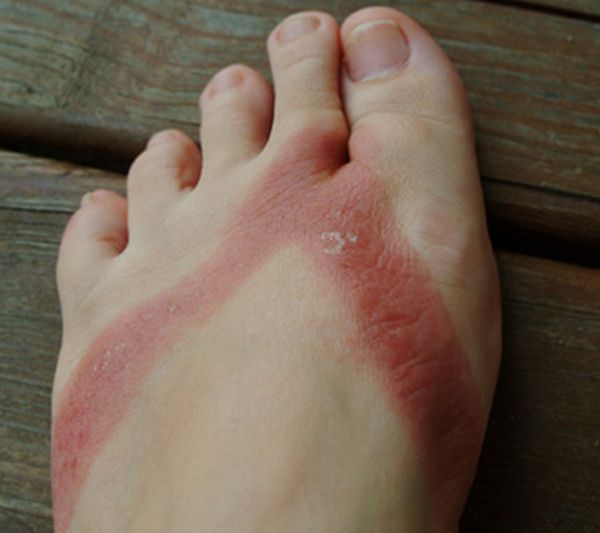 Pieds brulés par des sandales chimiques 03 pieds-brules-sandales-chimiques-03