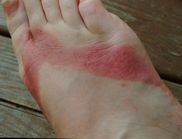 Pieds brulés par des sandales chimiques 04 pieds-brules-sandales-chimiques-04