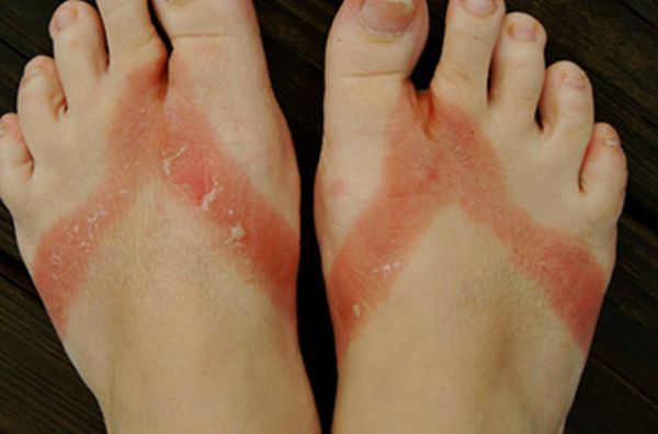 Pieds brulés par des sandales chimiques 06 pieds-brules-sandales-chimiques-06