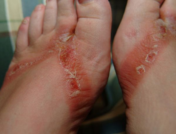 Pieds brulés par des sandales chimiques 08 pieds-brules-sandales-chimiques-08