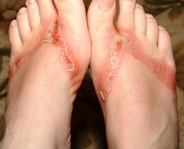 Pieds brulés par des sandales chimiques 09 pieds-brules-sandales-chimiques-09