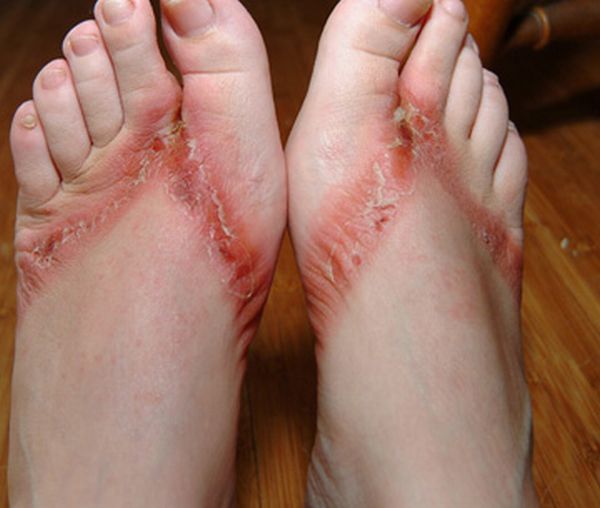 Pieds brulés par des sandales chimiques 10 pieds-brules-sandales-chimiques-10