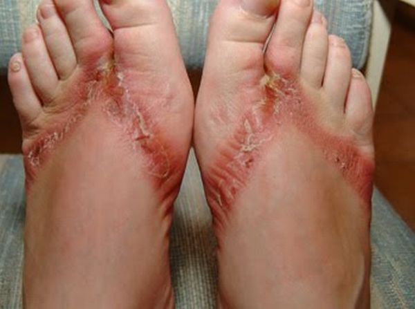 Pieds brulés par des sandales chimiques 11 pieds-brules-sandales-chimiques-11