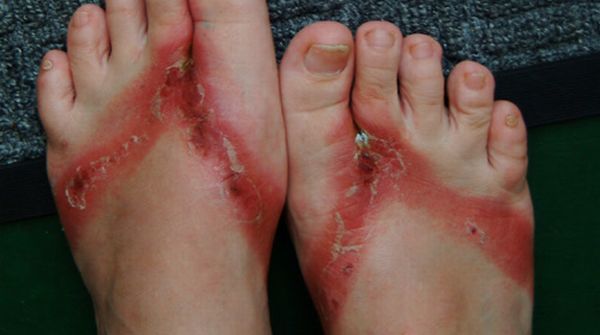 Pieds brulés par des sandales chimiques 12 pieds-brules-sandales-chimiques-12