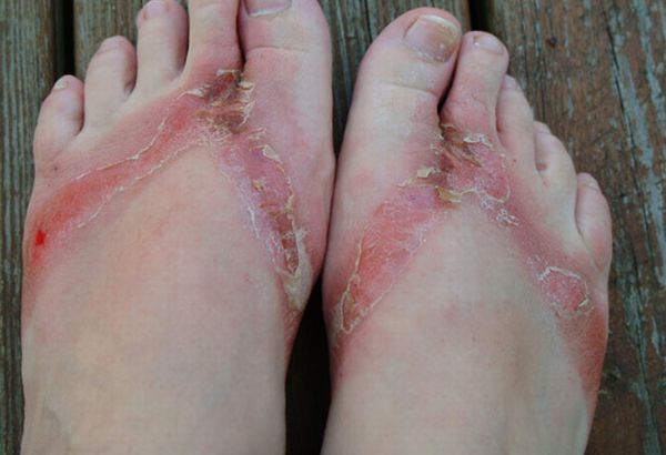 Pieds brulés par des sandales chimiques 13 pieds-brules-sandales-chimiques-13