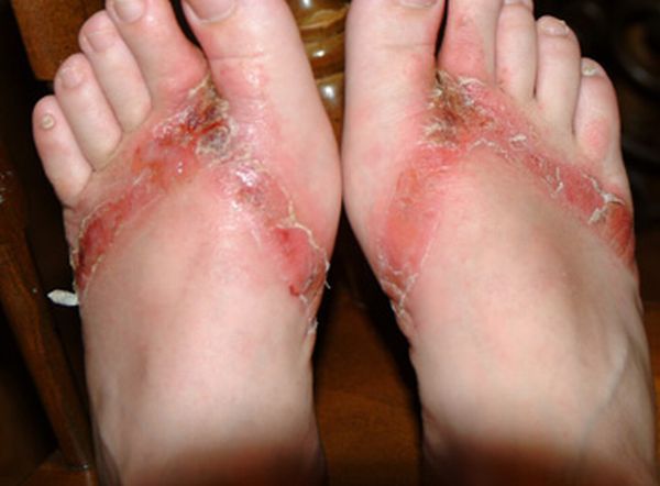 Pieds brulés par des sandales chimiques 14 pieds-brules-sandales-chimiques-14