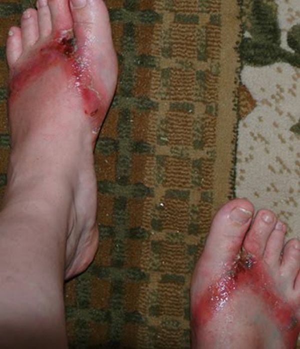 Pieds brulés par des sandales chimiques 15 pieds-brules-sandales-chimiques-15
