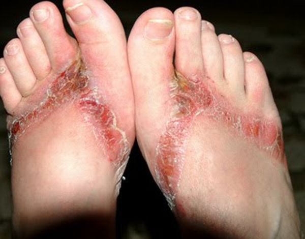 Pieds brulés par des sandales chimiques 16 pieds-brules-sandales-chimiques-16