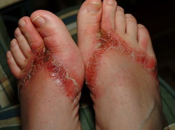 Pieds brulés par des sandales chimiques 17 pieds-brules-sandales-chimiques-17