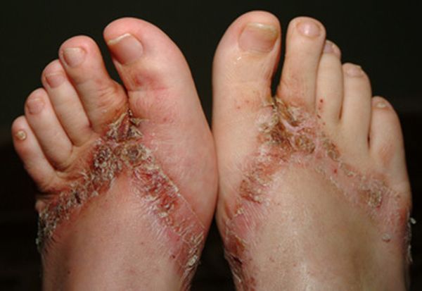 Pieds brulés par des sandales chimiques 18 pieds-brules-sandales-chimiques-18