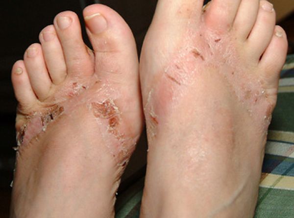 Pieds brulés par des sandales chimiques 19 pieds-brules-sandales-chimiques-19