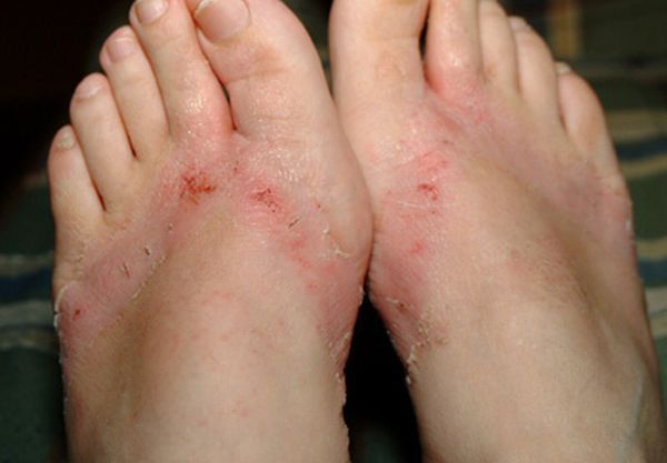 Pieds brulés par des sandales chimiques 20 pieds-brules-sandales-chimiques-20