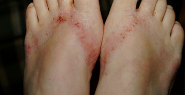 Pieds brulés par des sandales chimiques 21 pieds-brules-sandales-chimiques-21