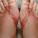 image pieds-brules-sandales-chimiques